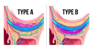 Diagram showing the correct layering of dermal filler in the deep sub-orbicularis plane.